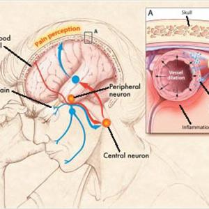 Migraine Headache Relief - Finding A Migraine Doctor