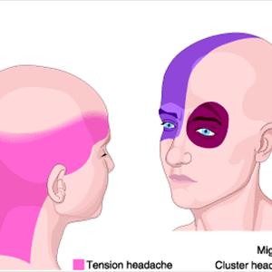 Migraine Pathophysiology - Treatment Of Migraine Headaches Using Natural Methods