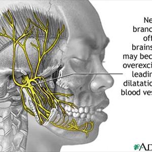 Mirena Migraine Vids - Common Migraine Symptoms