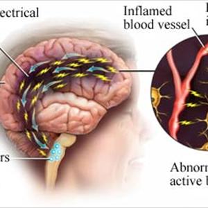 Prolonged Headache - Natural Remedies For Migraine Relief