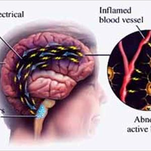 Headache Center Of North Texas - 3 Special Tips About Migraine Headache Remedy